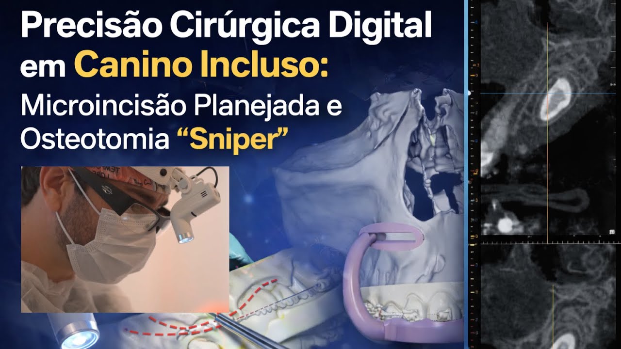 Capa do vídeo: precisão cirúrgica digital em canino incluso, conduzida pelo Dr. Fernando Giovanella